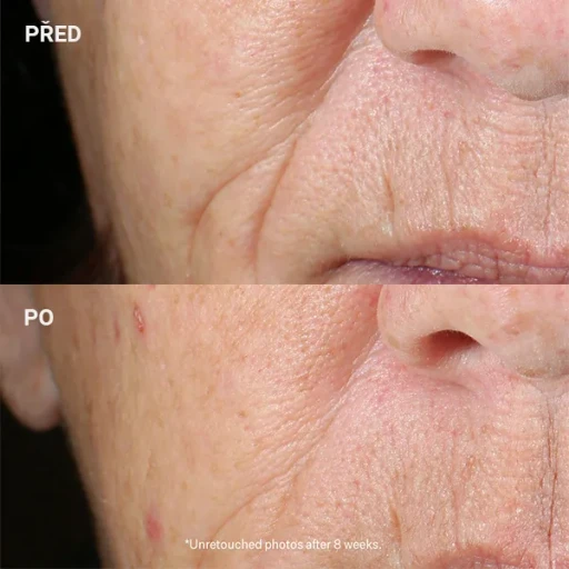 StriVectin-Peptight-Tightening_Brightening-Face-Serum_AURIO_before_after