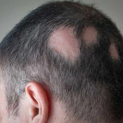 alopecia_areata_aurio